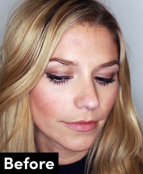 Botox - before and after pics Botox - before and after pics