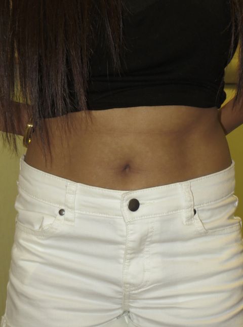 Belly Button Surgery Before After Pictures Realself Images 