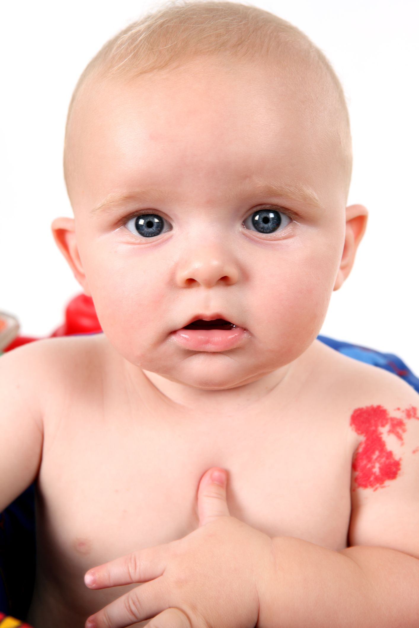 Birthmarks: causes, types, and treatment and when to be concerned