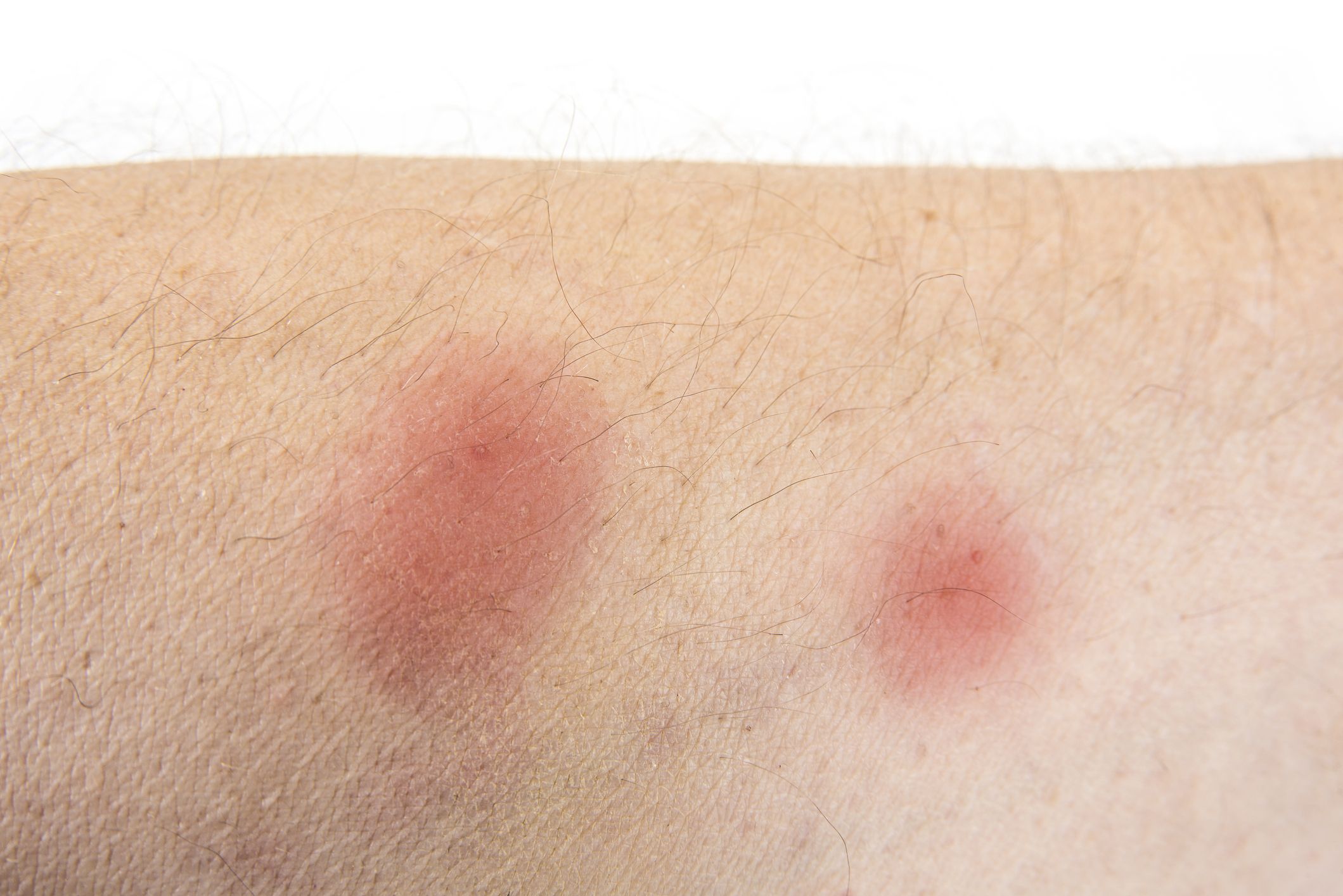 These Bug Bite Pictures Can Help You Identify A Mosquito Bite Tick