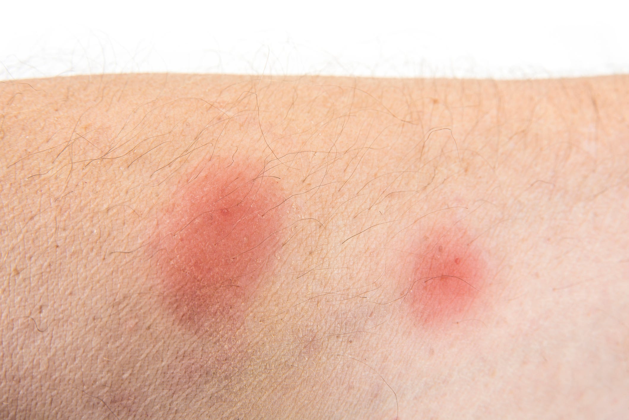 These Bug Bite Pictures Can Help You Identify A Mosquito Bite Tick Bite Spider Bite And More 