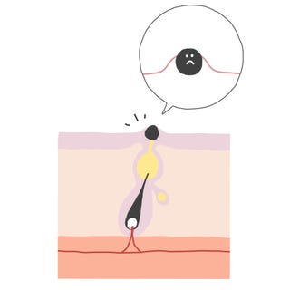 ニキビの集中ケア術etc 種類別 ニキビの原因と対策を皮膚科医にask ニキビの集中ケア術etc 種類別 ニキビの原因と対策を皮膚科医にask