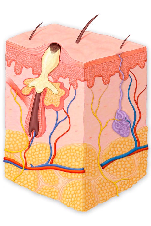Skin cross section showing a blackhead Skin cross section showing a blackhead