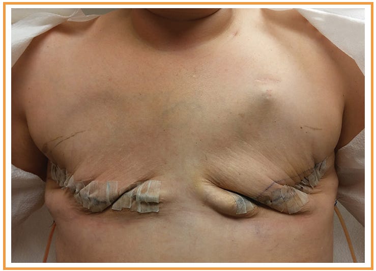 double mastectomy before and after