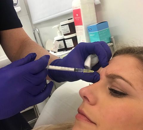 Botox - everything you need to know 