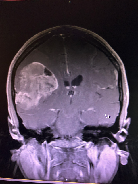 glioblastoma mri brain scan