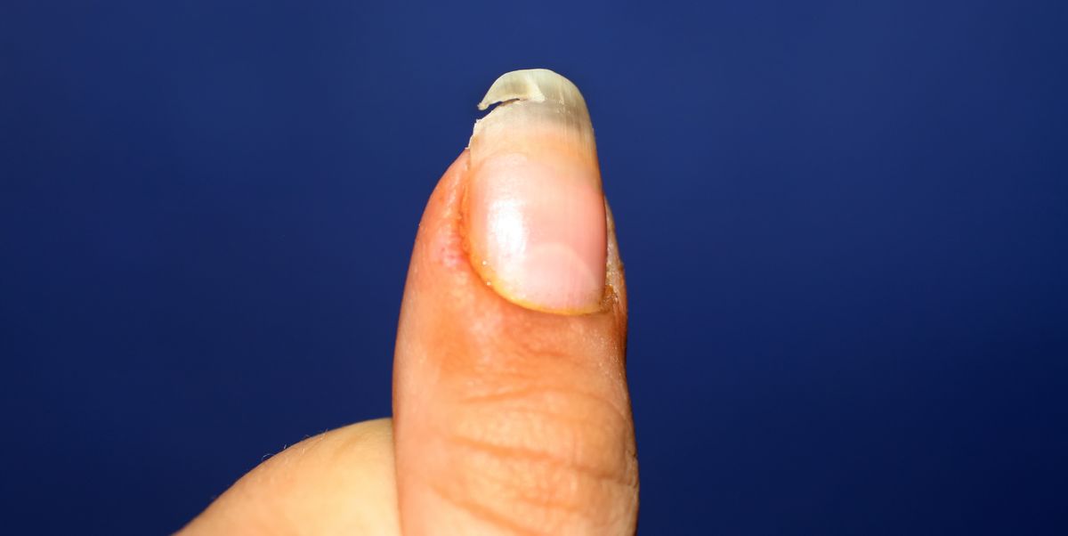 How to Fix a Broken Nail At Home, According to Dermatologists