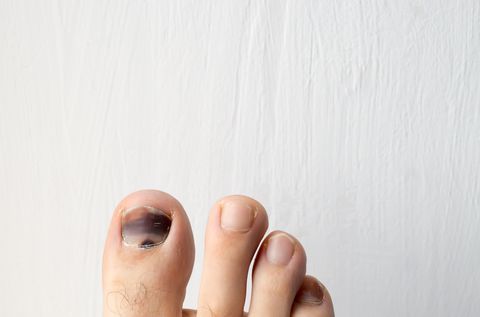 bruised black toenail
