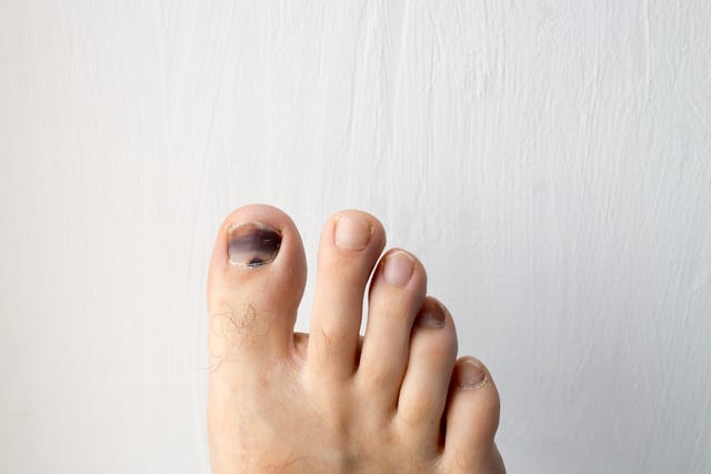 5 Black Toenail Causes To Know Why Is My Toenail Black