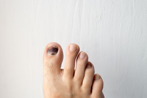bruised nail foot