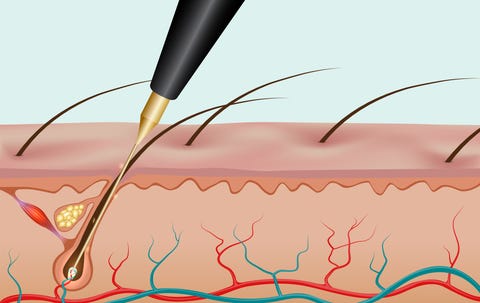 Burning hair root with needle epilation Burning hair root with needle epilation