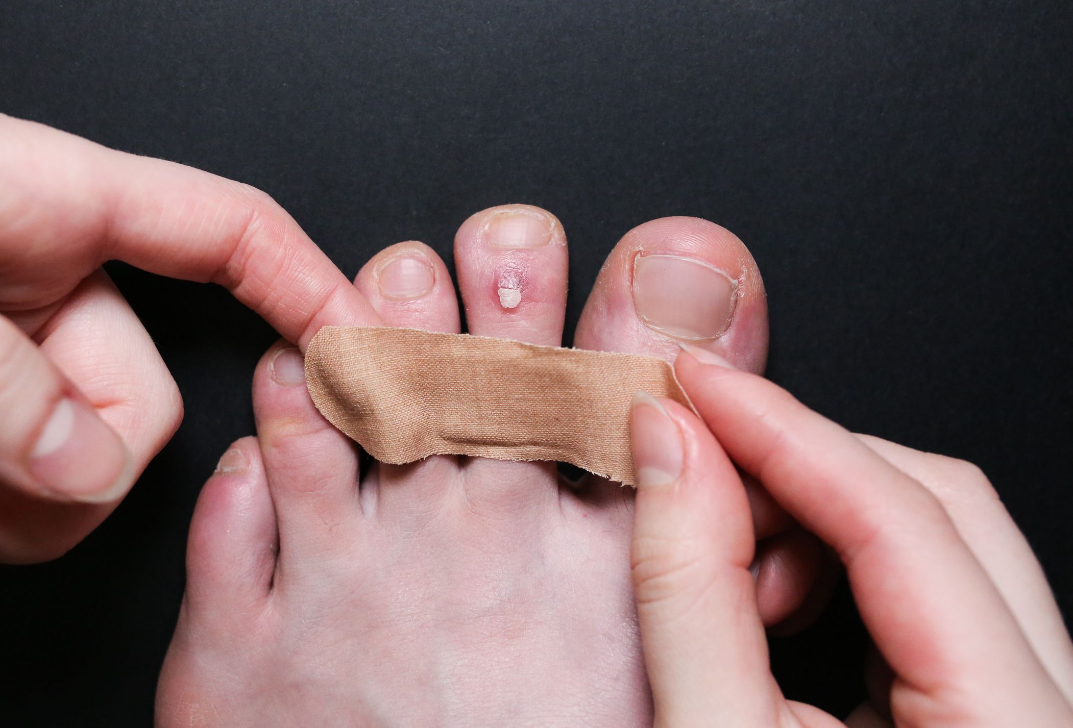 How To Get Rid Of Blisters Blisters From Running