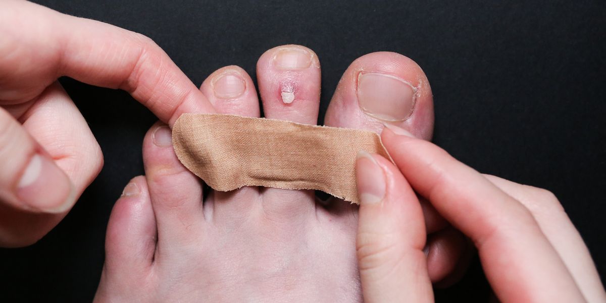 How to Get Rid of Blisters | Blisters From Running