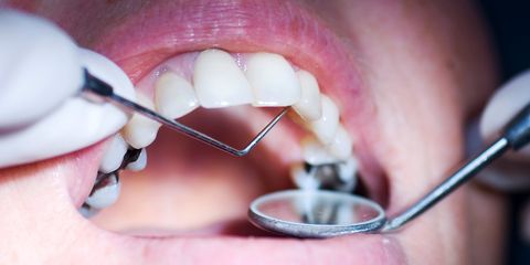 how to fix a cavity