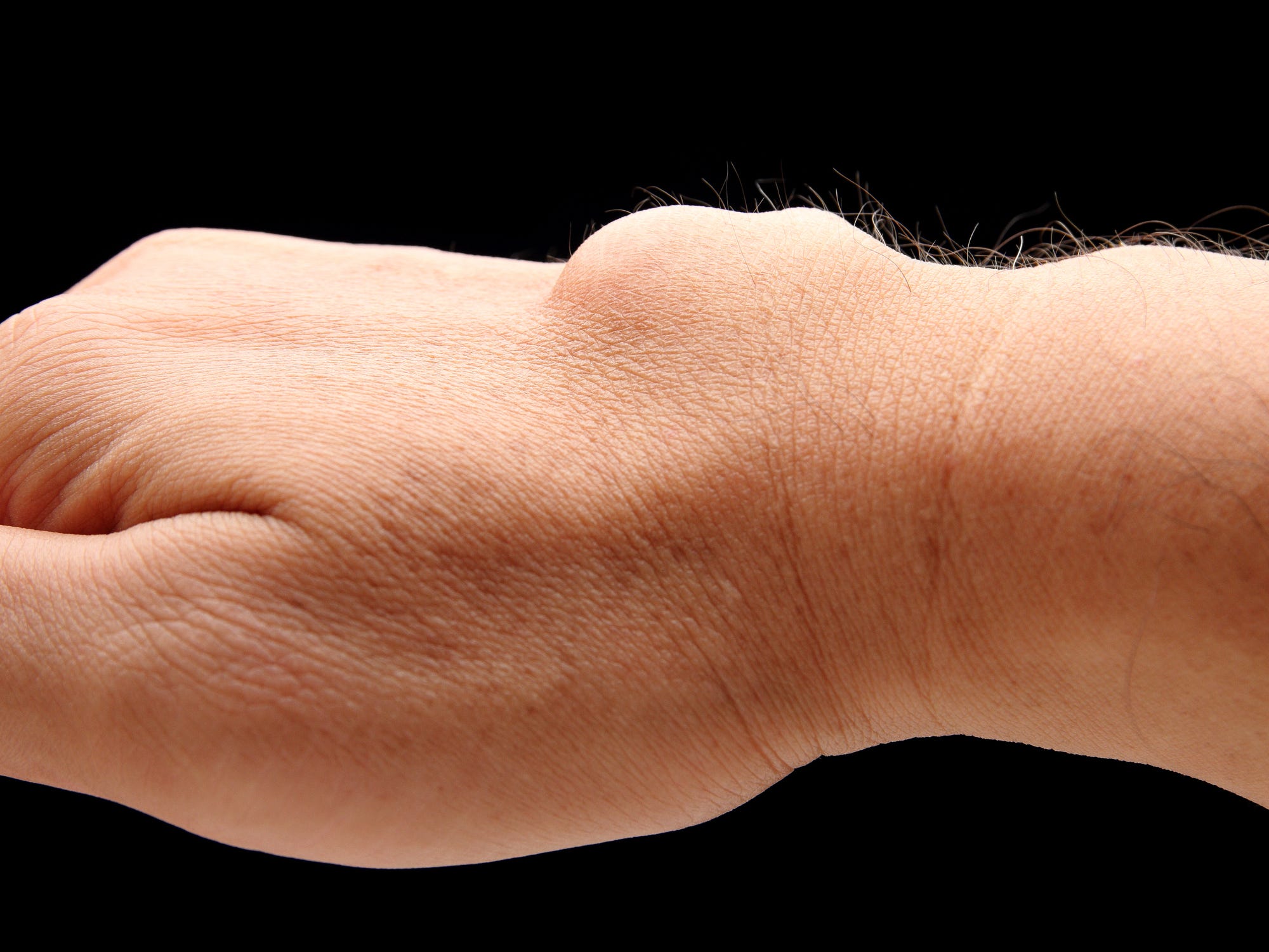 carpal ganglion cyst