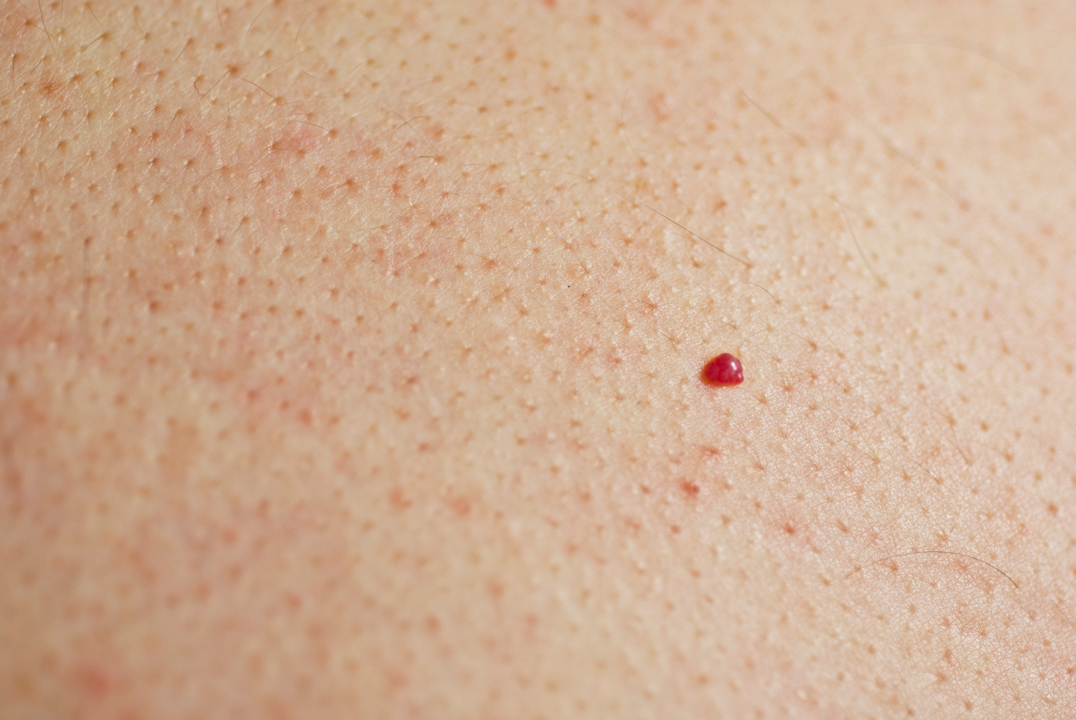 two pinpoint red dots on skin