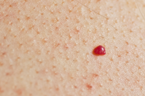 cherry angioma