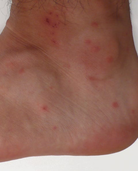 Itchy Bumps On Skin Like Mosquito Bites Sea Lice That Nasty Rash You