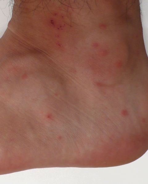 what do chigger bites look like
