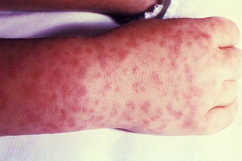 Rocky Mountain spotted fever Rocky Mountain spotted fever