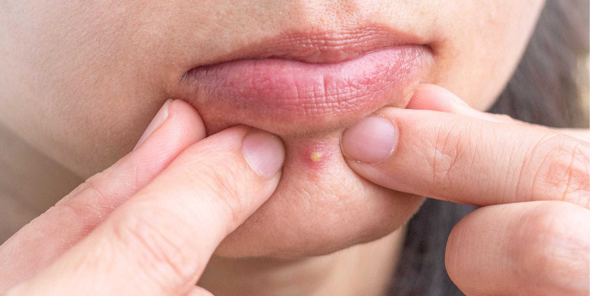 Chin acne: 5 ways to deal with a spotty chin and what causes it