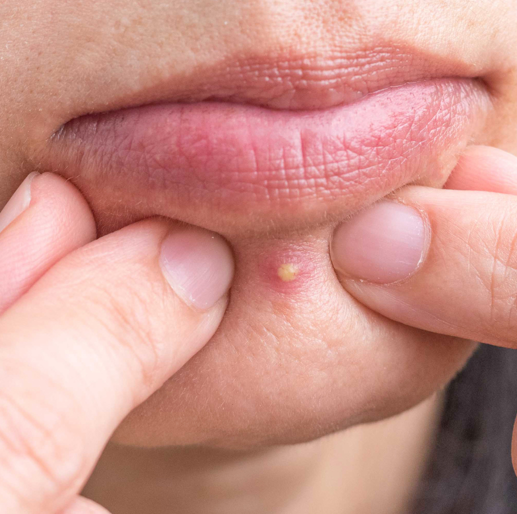 Chin acne: 5 ways to deal with a spotty chin and what causes it