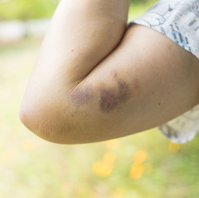 List 100+ Images pictures of bruises on arms Superb