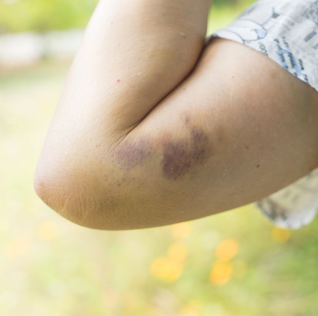 Close up Bruising on the old woman arm. Woman violence concept, bruises on arm.