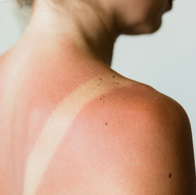 close up of a sunburn marks on a woman's back