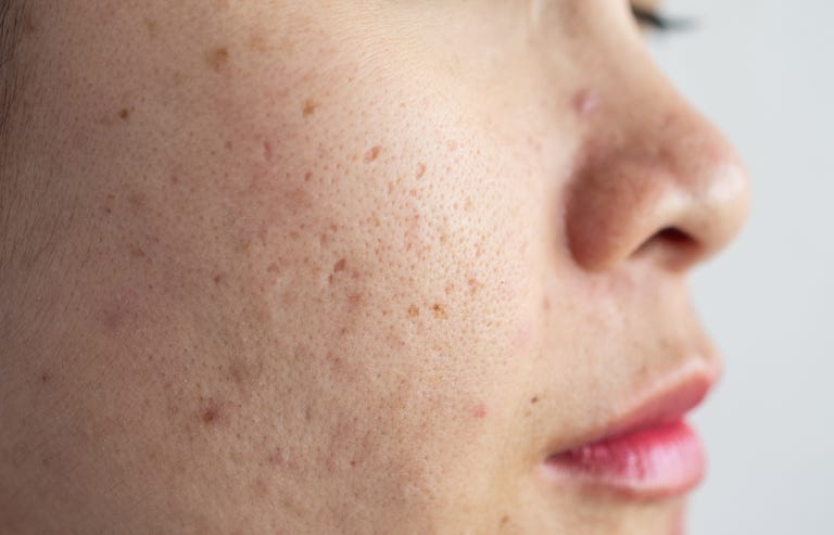 Close up di donna Asiatica, faccia ha problemi con l'invecchiamento della pelle/acne cicatrice sul viso.