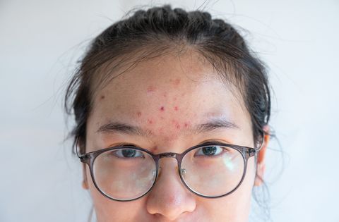 close up of asian woman with pimple and acne inflamed on her forehead