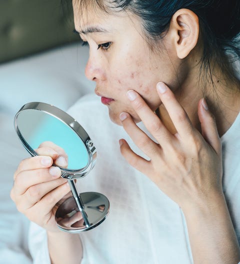 Acne scar treatment: how to get rid of acne scars Acne scar treatment: how to get rid of acne scars