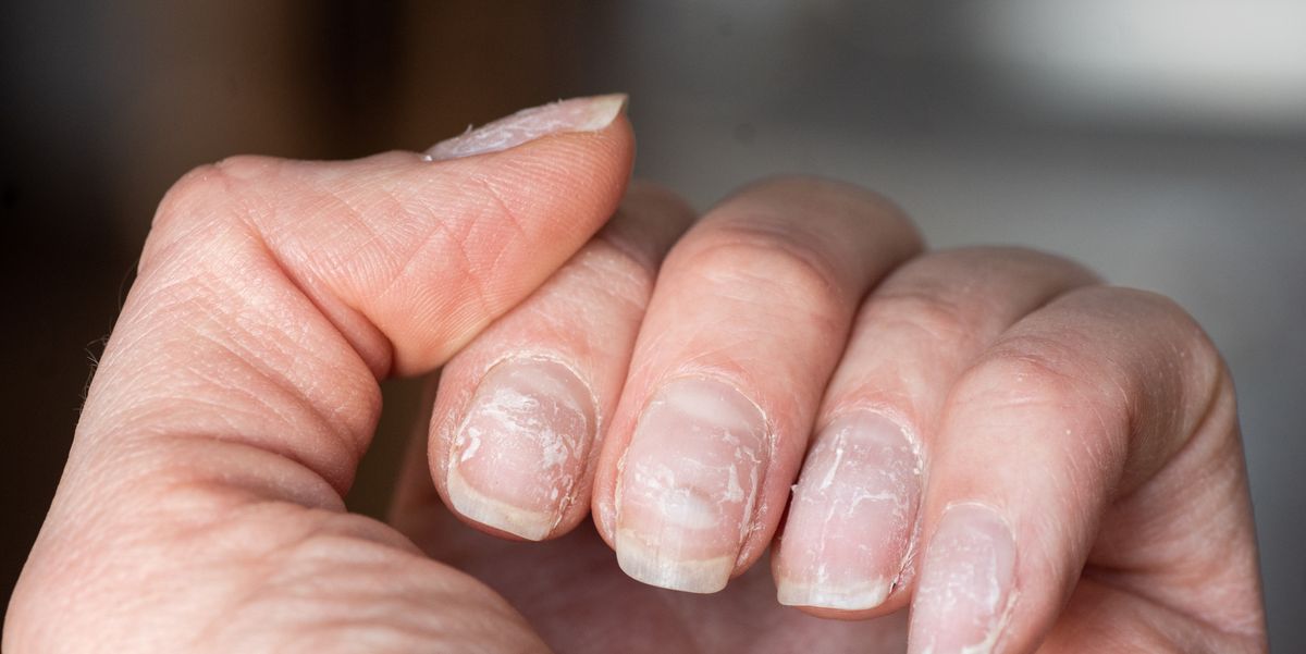 Why are my nails peeling?