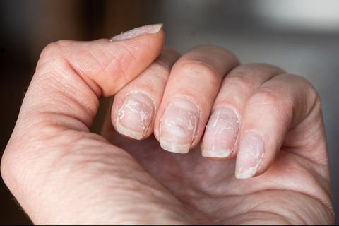closeup of brittle nails damaged in the nail after using shellac or gel nail polish