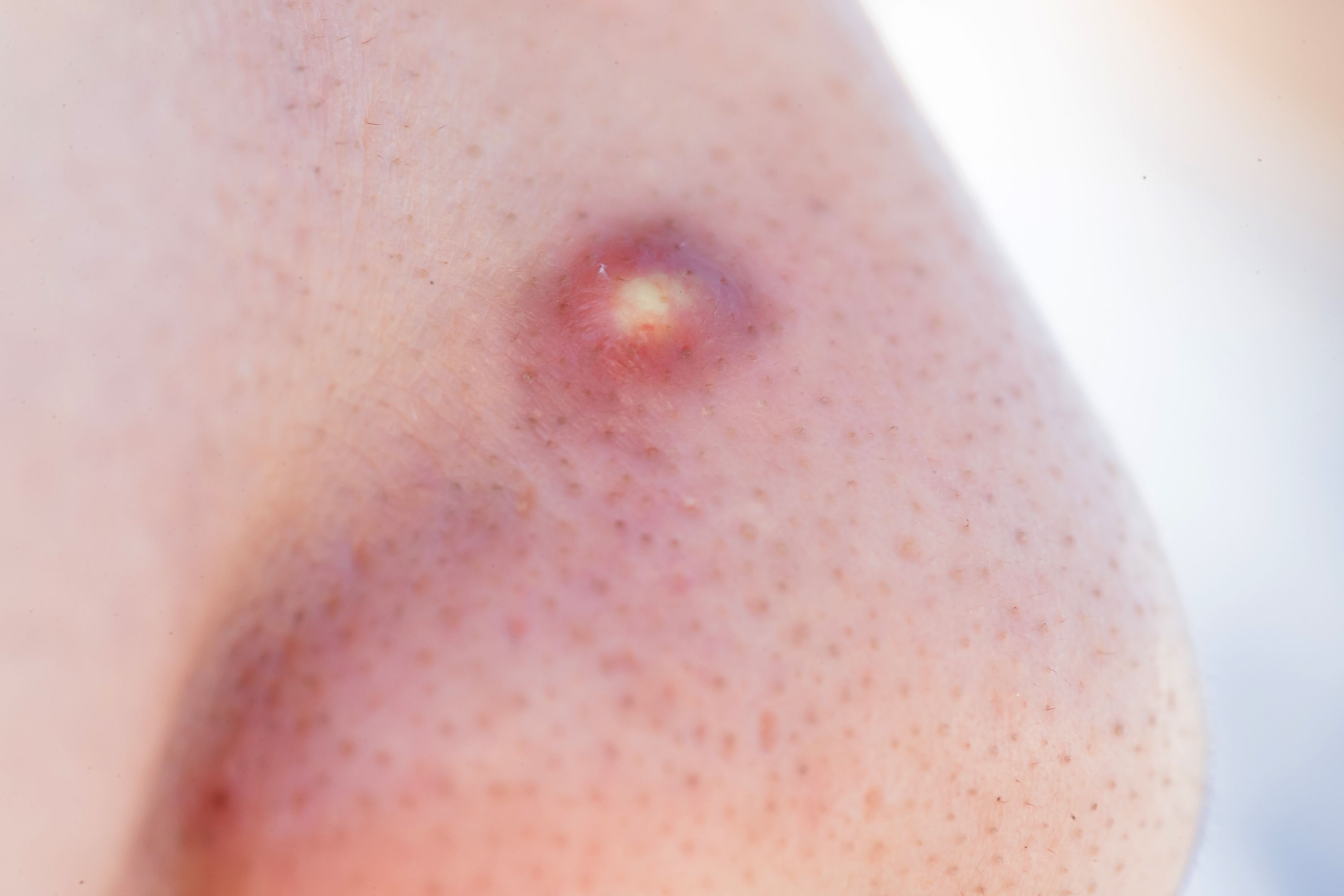 The 10 Most Satisfying Pimple Popping Videos Of 18