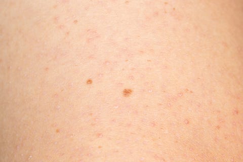 Close up of keratosis pilaris on the arm of a young caucasian man