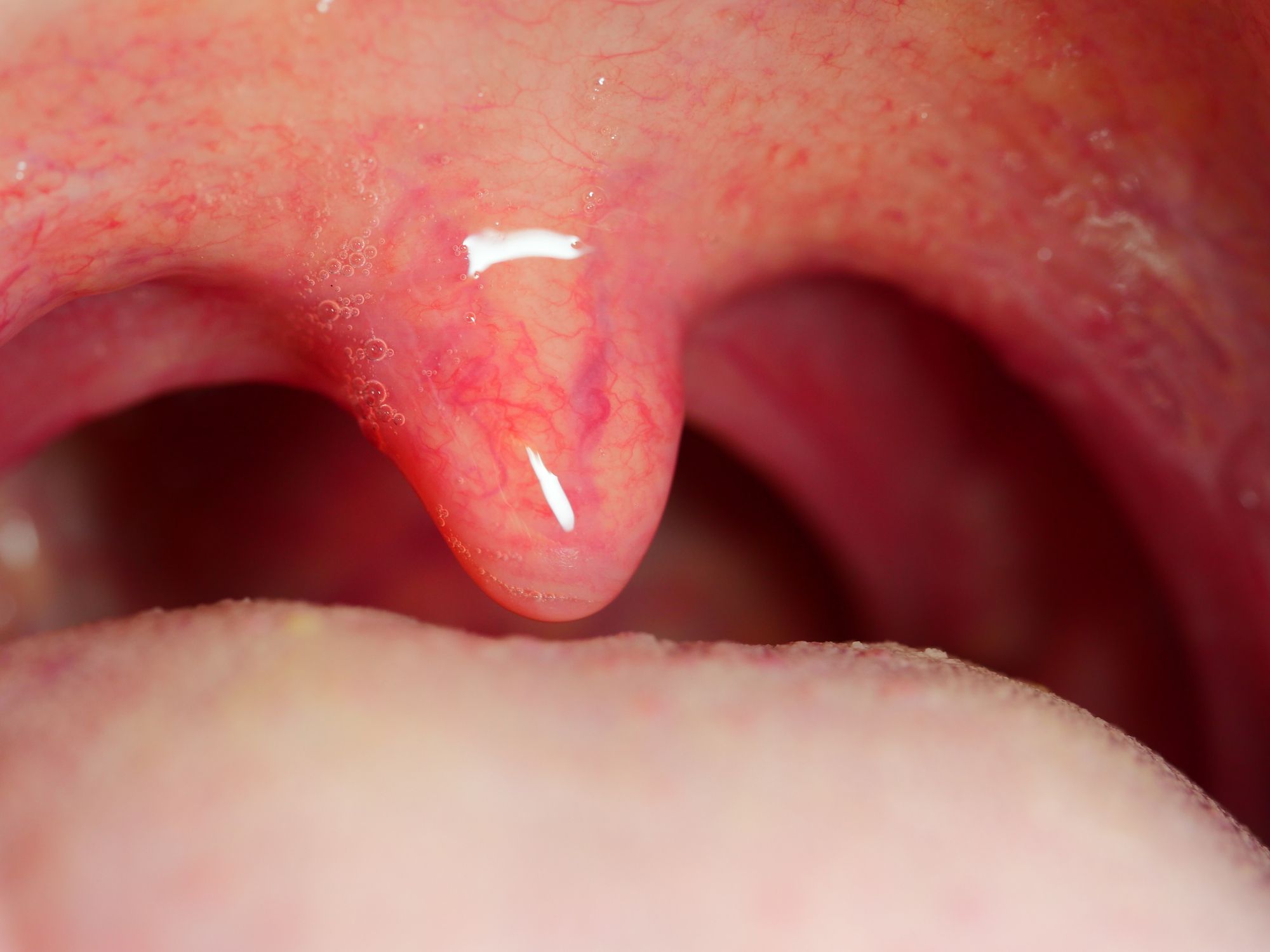 Papilloma wart on the uvula - Viral papilloma uvula