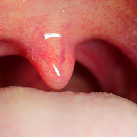 9 Swollen Uvula Uvulitis Causes Why Is My Uvula Swollen