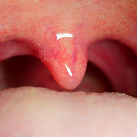 papilloma on the uvula