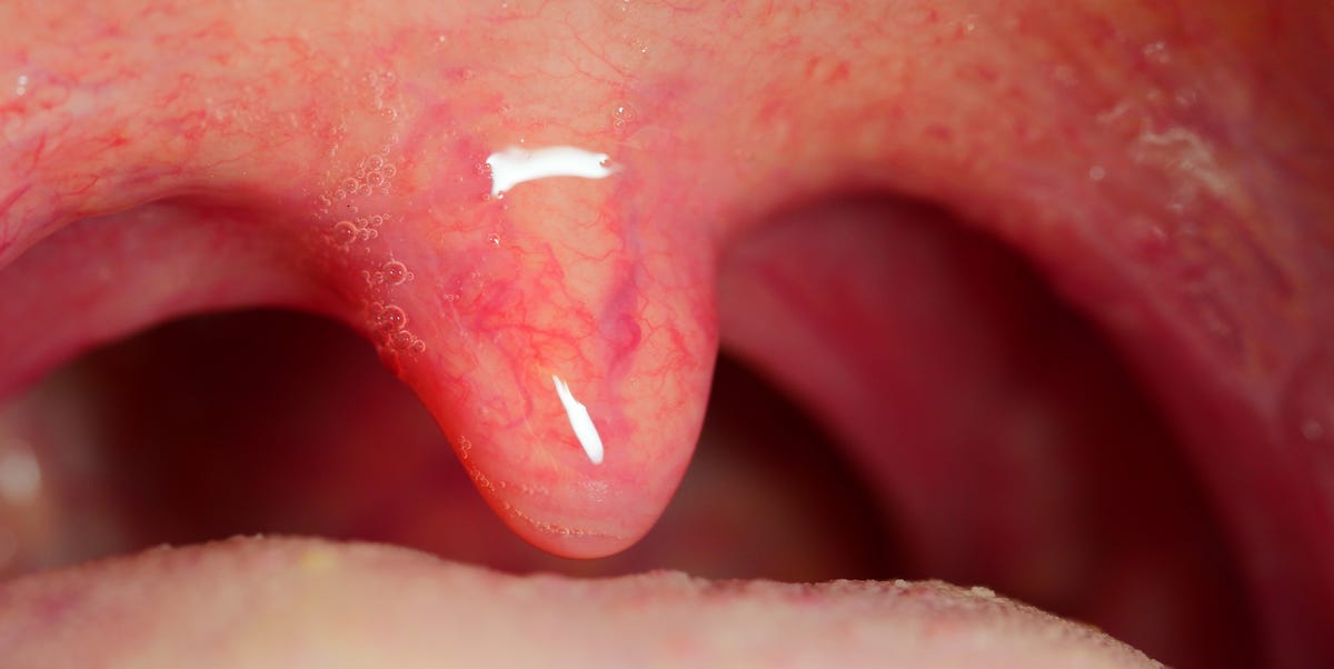 papilloma growth on uvula