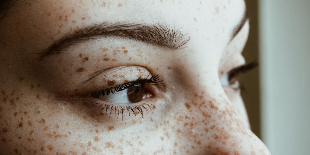 Freckles Explained How To Check Your Spots For Cancer Or Other Irregularities