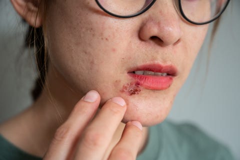 Herpes genital: qué es y cuándo puede retomarse el sexo Herpes genital: qué es y cuándo puede retomarse el sexo