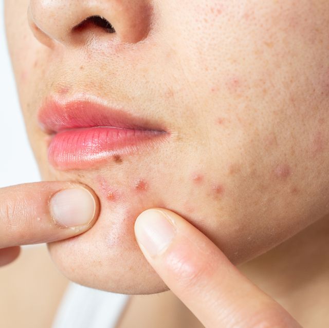 close up of woman pointing acne inflammation papule and pustule on her face
