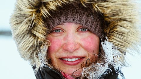 冬は気を付けたい 皮膚科医に聞いた 顔の 風焼け 予防と対処法