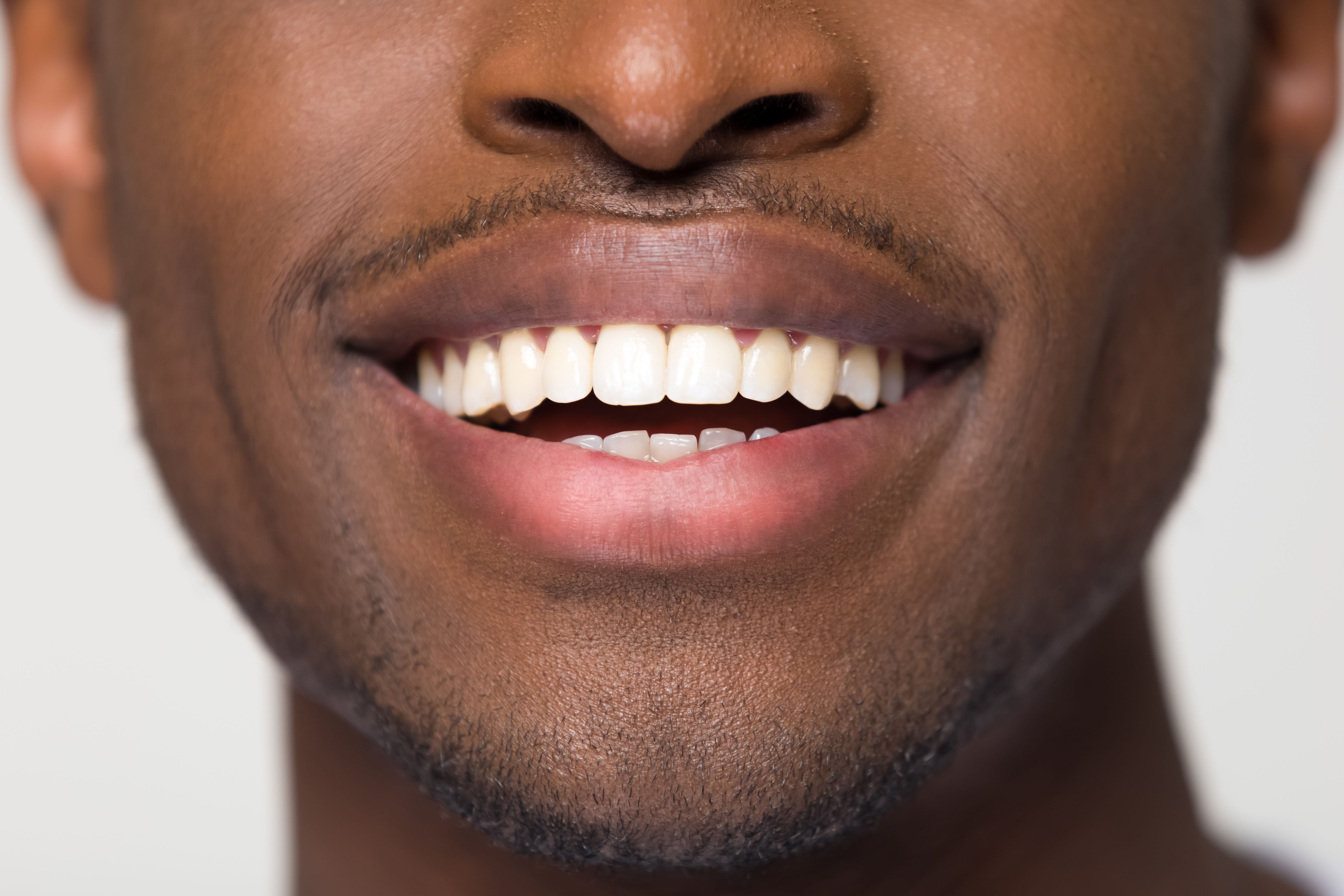 The Definitive Guide to Best Over The Counter Teeth Whitening Kits