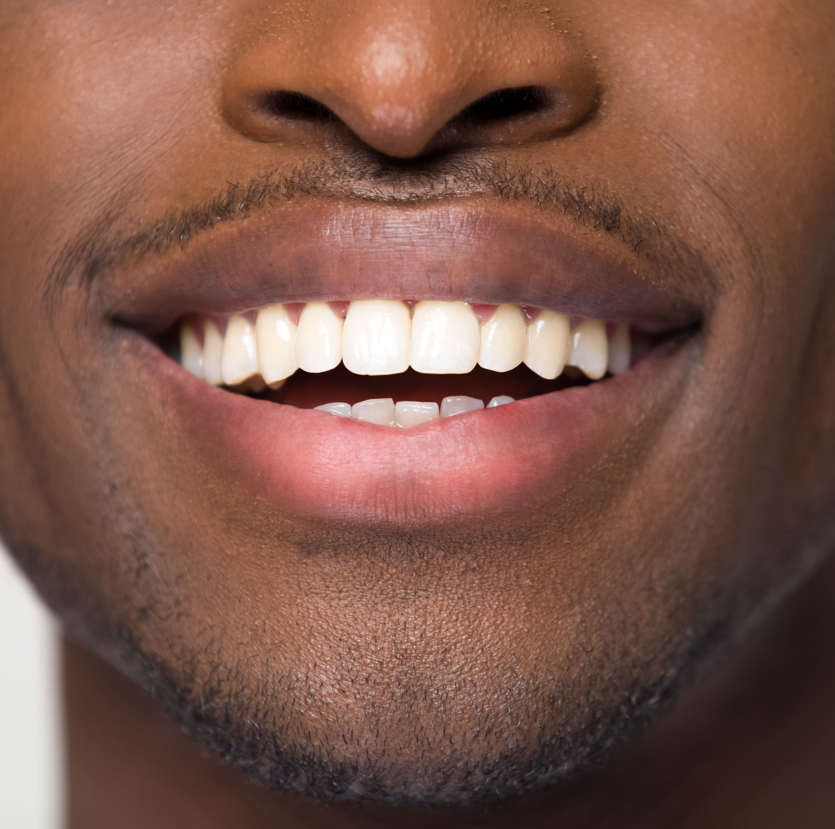 The Best Tooth-Whitening Kits, According to Dentists
