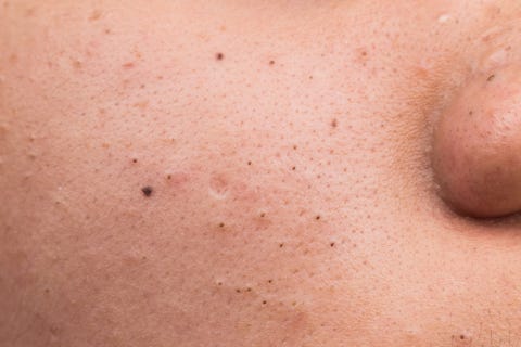 How to Get Rid of Blackheads: Symptoms, Causes and Treatments