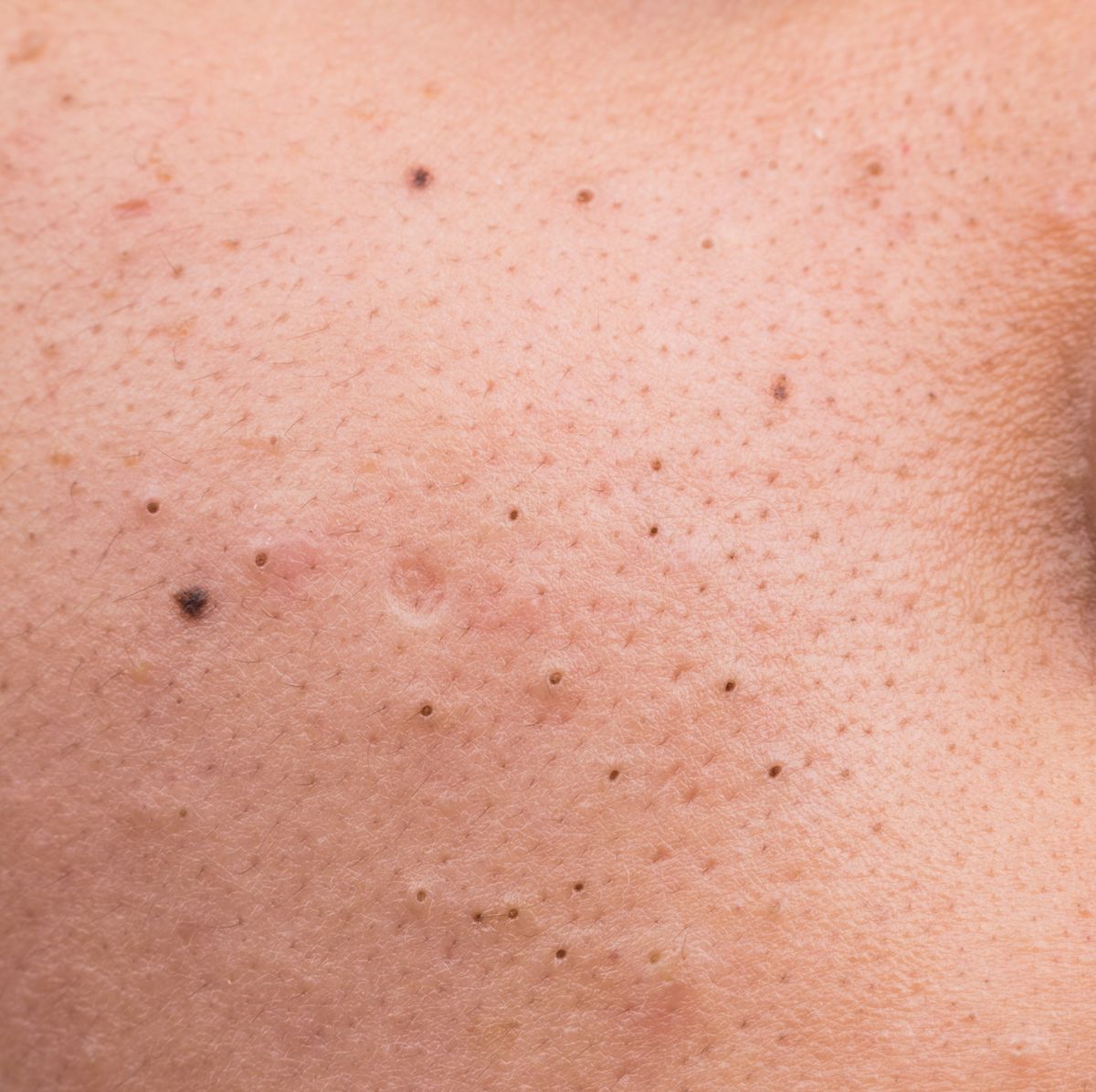 How to Get Rid of Blackheads: Symptoms, Causes and Treatments
