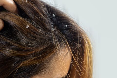 closeup hair with dandruff scalp,seborrheic dermatitis