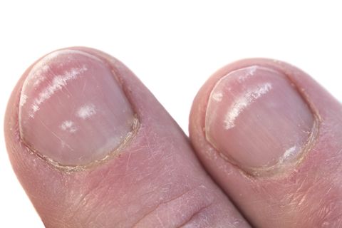 closeup of two fingernails with leukonychia